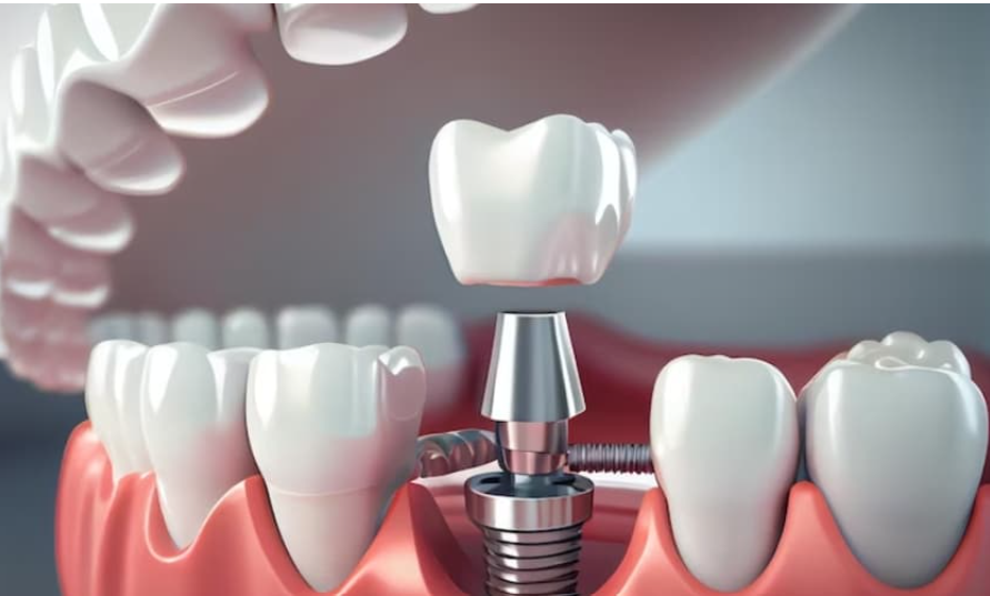 Understanding the Dental Implant Procedure: Step-by-Step Walkthrough